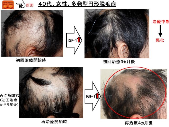 円形脱毛症　病院